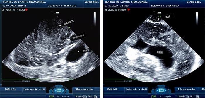 左圖顯示術中超聲見囊實性病變，大小約為4x4x3cm，病灶周圍腦組織水腫明顯；右圖為病灶切除后，術中超聲示術腔無病變殘留