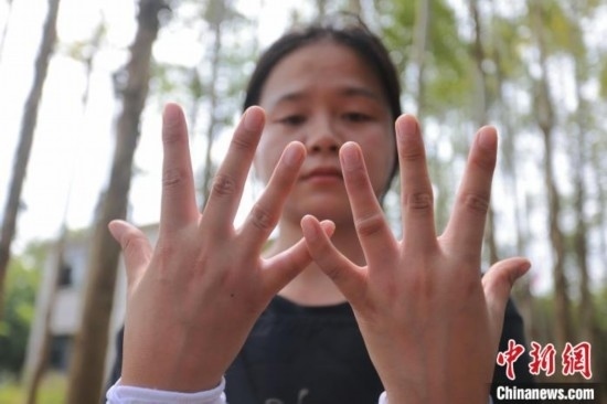 吳素英展示被蜜蜂蜇過的雙手。湯曉逵 攝