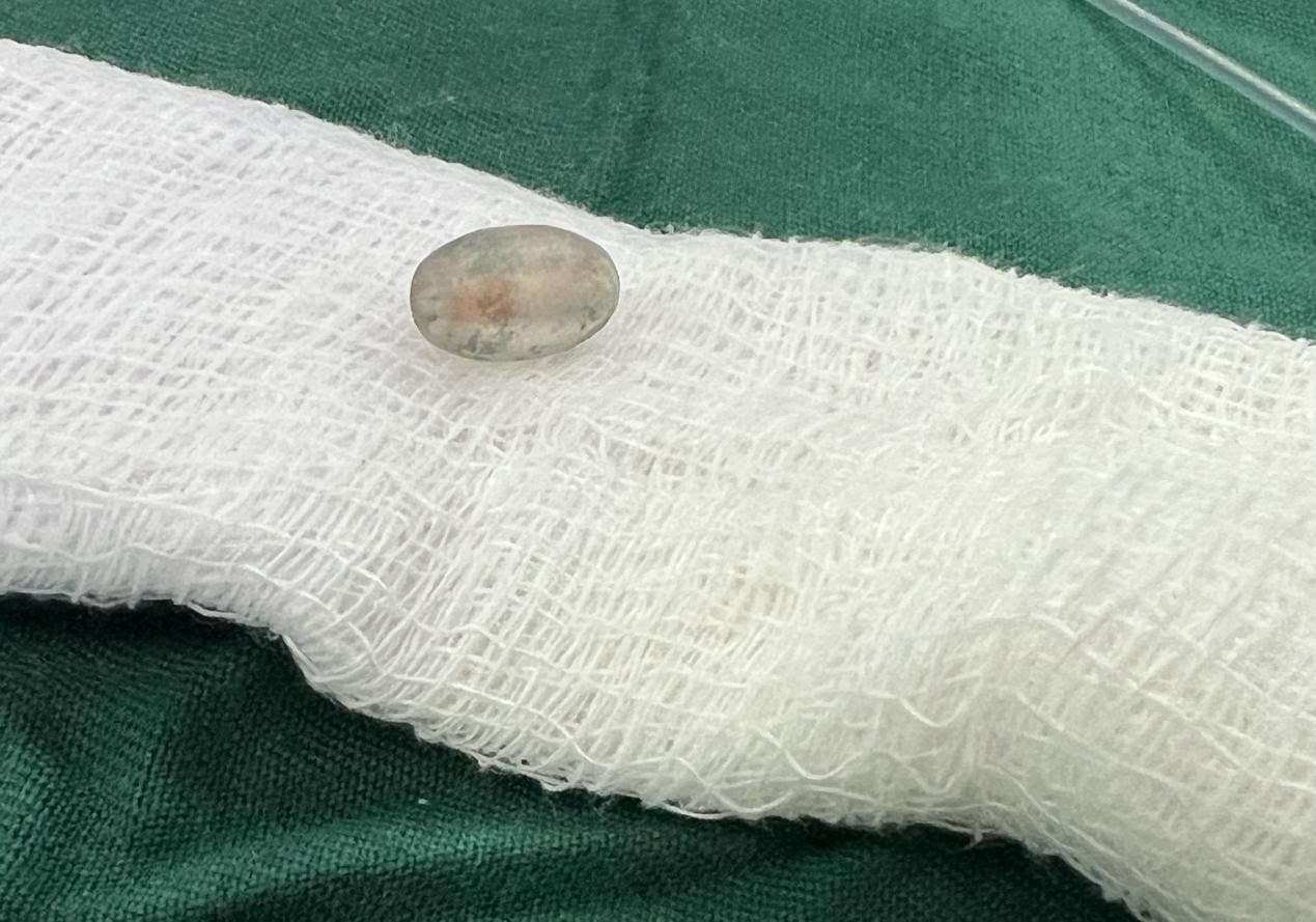 被取出的異物。中國援桑醫(yī)療隊(duì)供圖