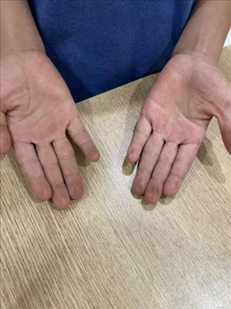 9歲小學(xué)生長(zhǎng)期拍煙卡，手部粗糙長(zhǎng)繭。受訪者供圖