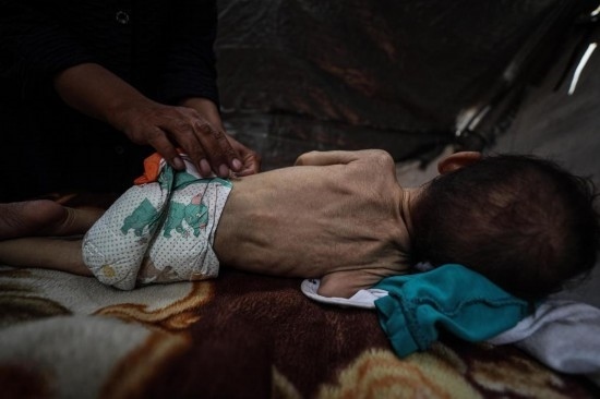 這是5月28日在加沙城西部一處臨時(shí)安置點(diǎn)拍攝的一名營(yíng)養(yǎng)不良的嬰兒。新華社發(fā)（馬哈茂德·扎基攝）